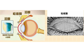 运用强脉冲光治疗睑板腺功能障碍相关干眼症
